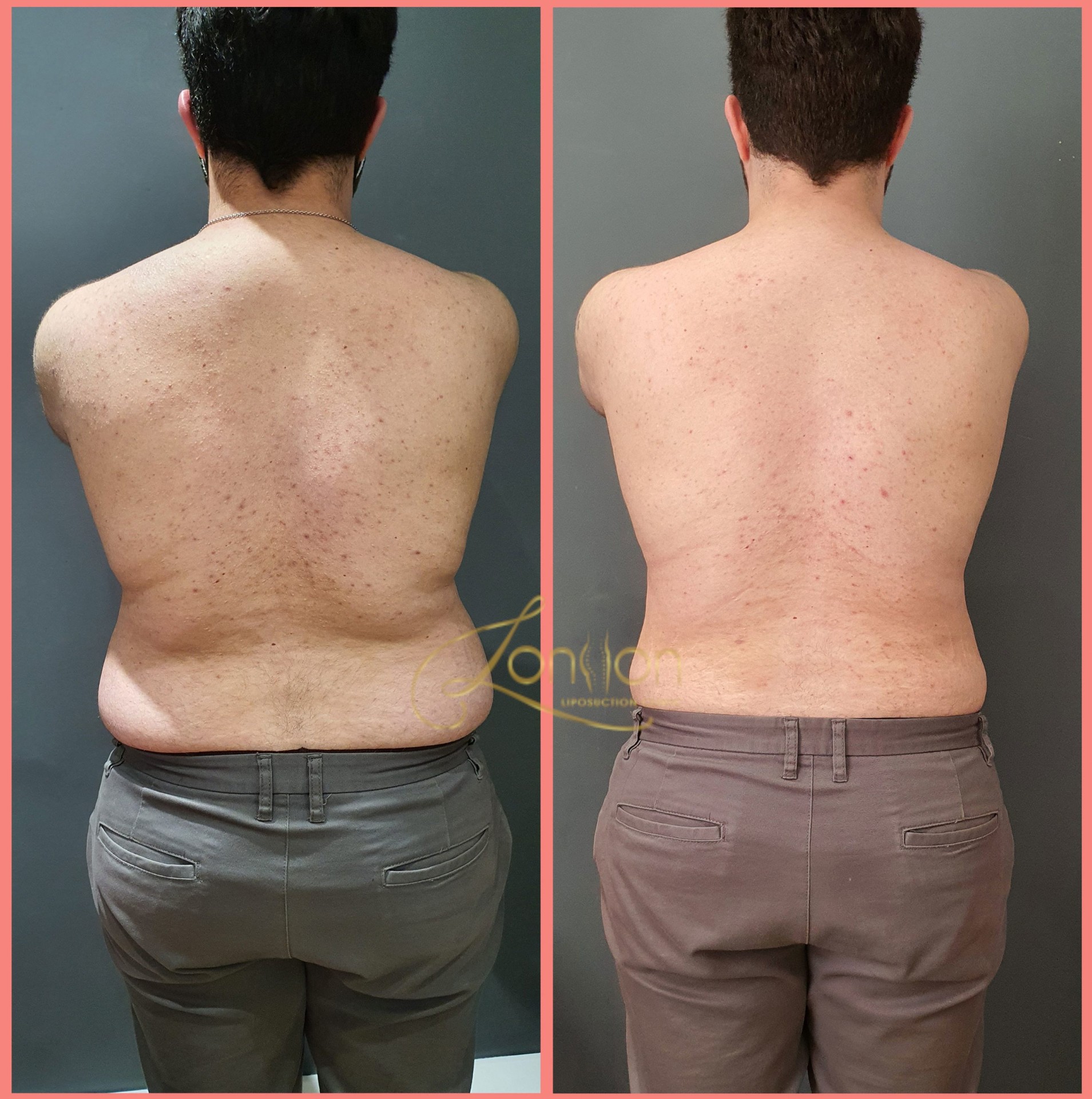 Male back and sides liposuction
