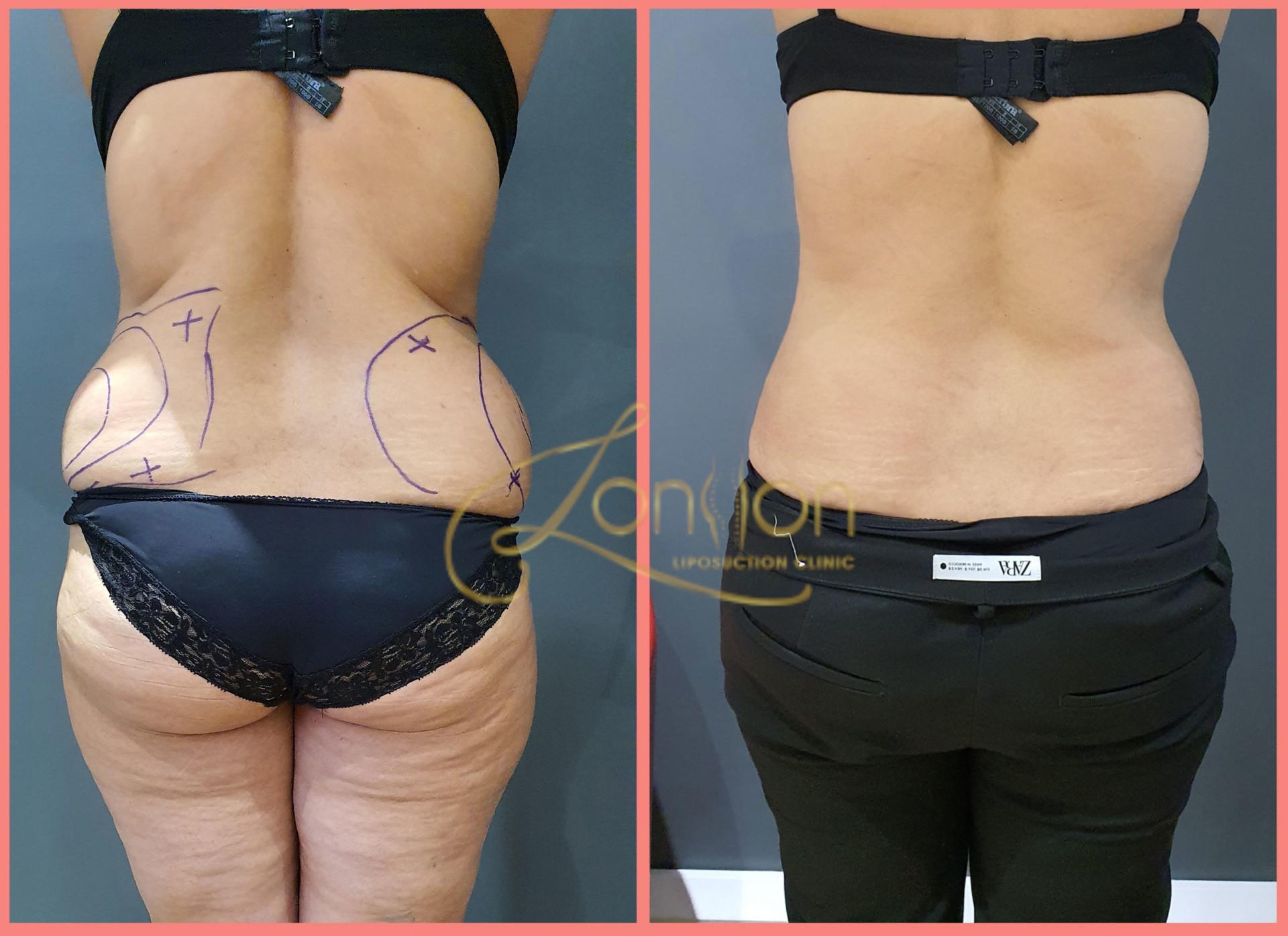 Flanks and lower back contouring