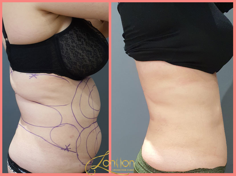 Abdomen sides liposuction