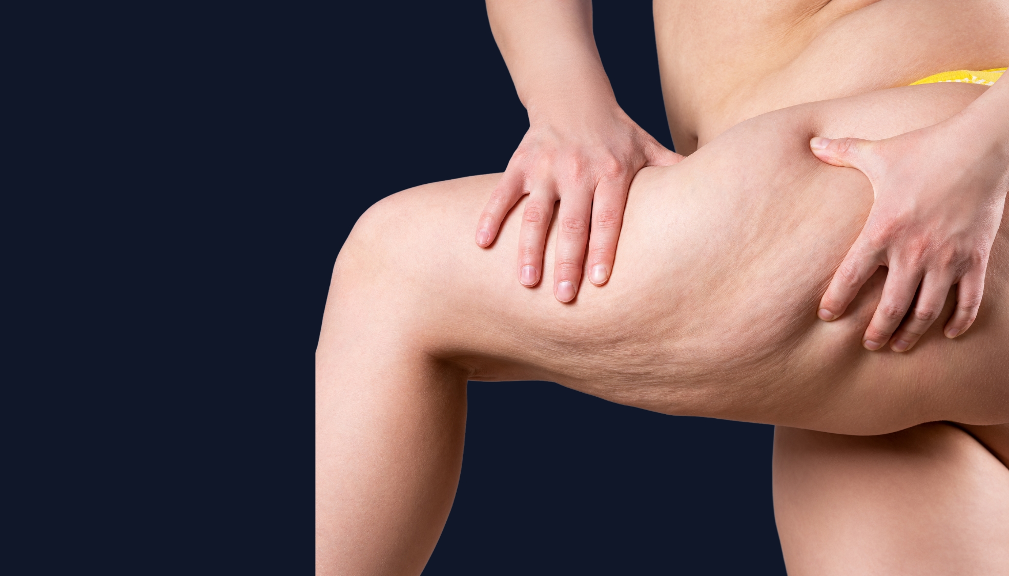 Inner & outer thigh liposuction in London — sculpted leg contour at London Liposuction Clinic