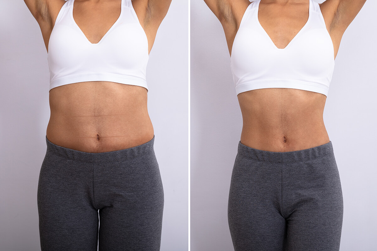 Abdomen liposuction before and after