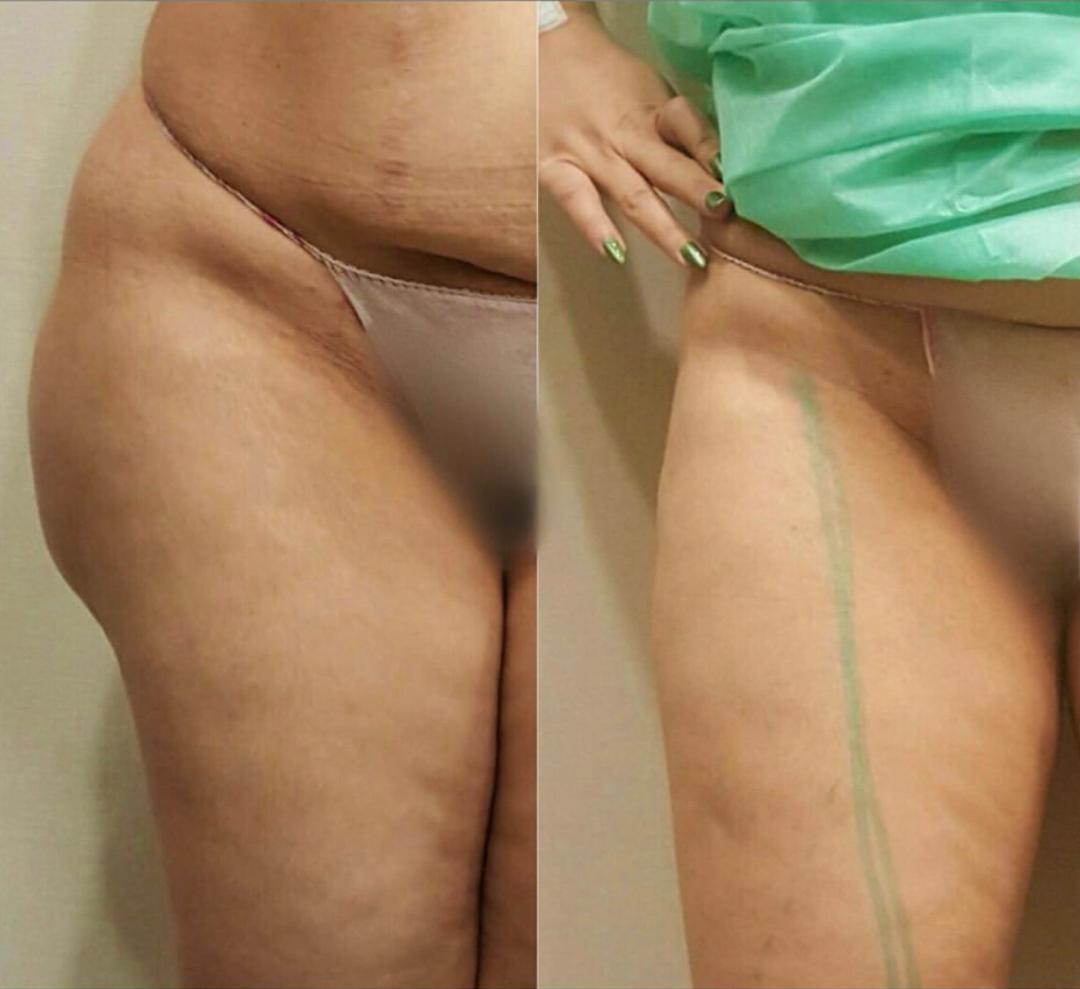 Hips and thighs liposuction