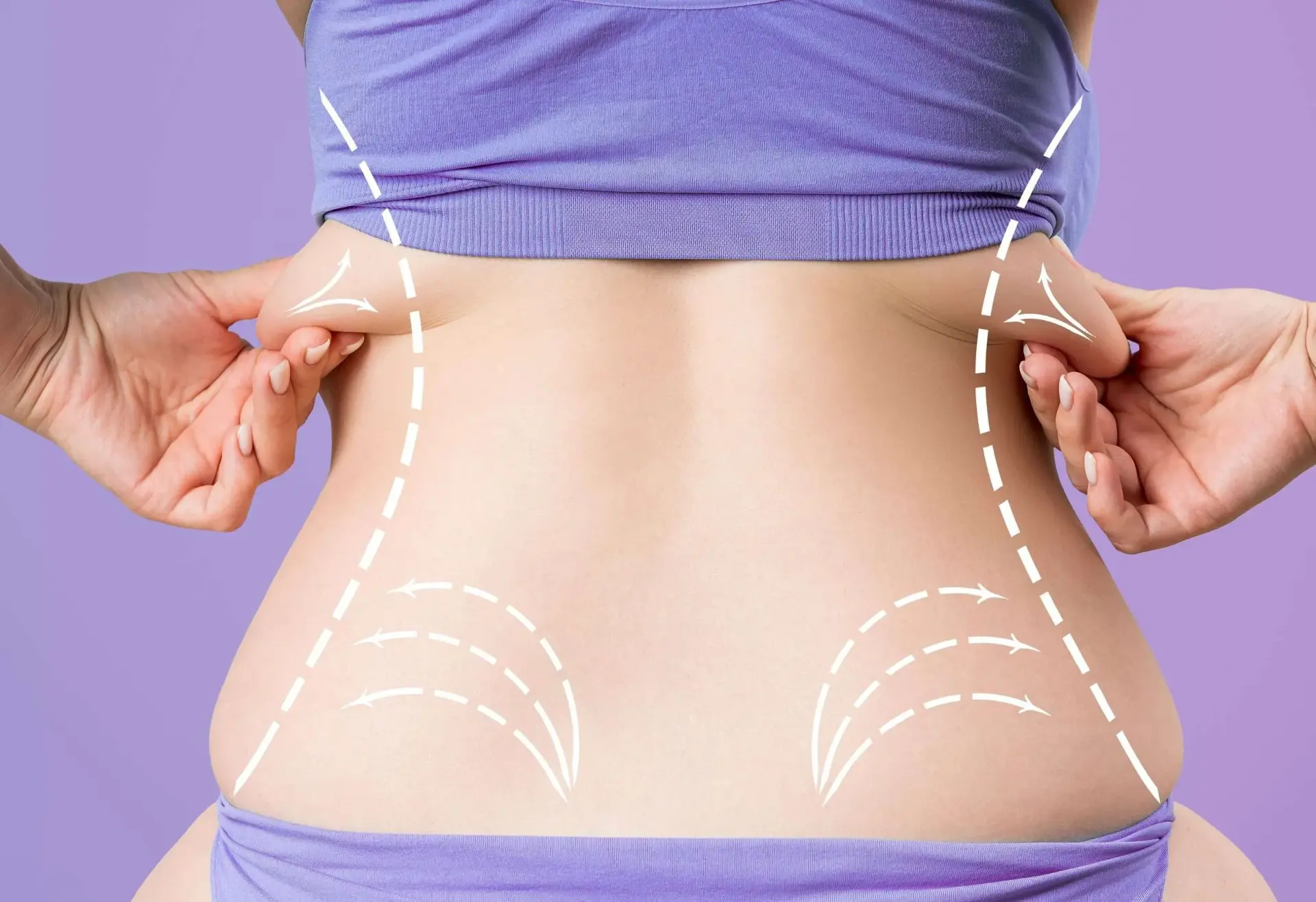 Liposuction vs Weight Loss Injections: Which Option Is Right for You? — liposuction in London