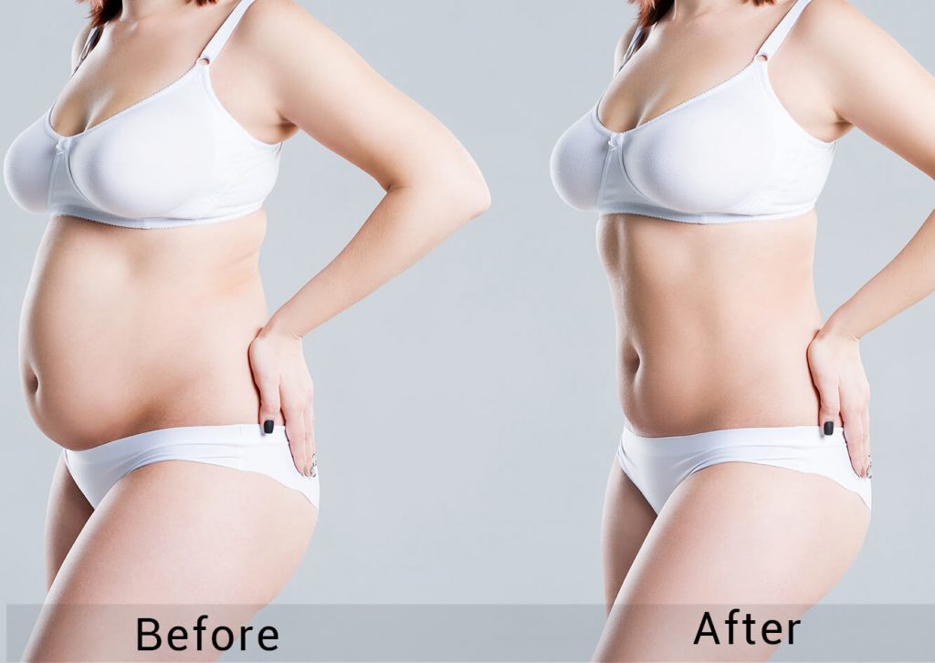 Visual overview of 2026 liposuction trends shaping patient demand in London