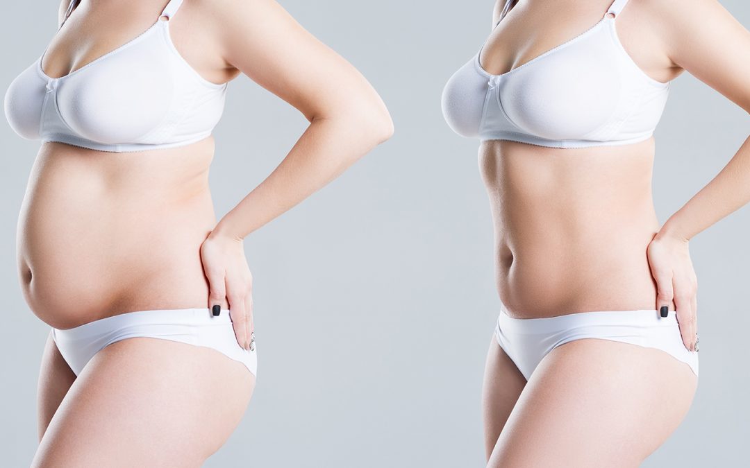 2026 Liposuction London Trends: What Patients Are Requesting