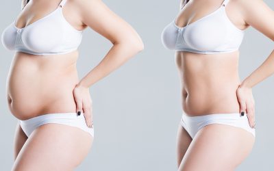 2026 Liposuction London Trends: What Patients Are Requesting