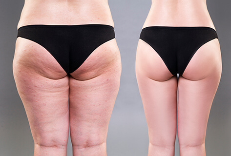 inner thigh fat removal
