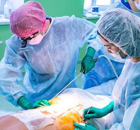 Liposuction surgeries have rising result rates for successful implementation