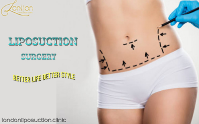 Liposuction 0% finance – get services at our clinic