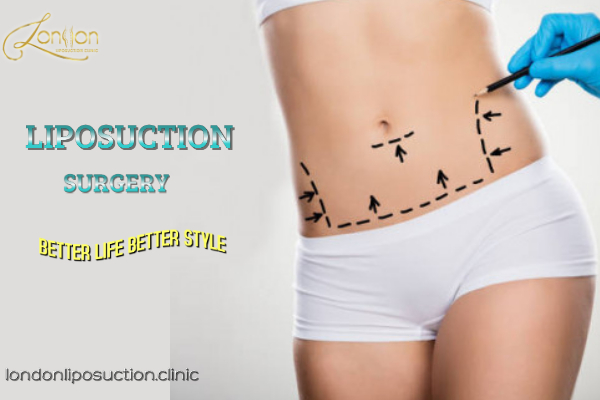 London liposuction