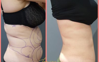 Stomach Fat removal 