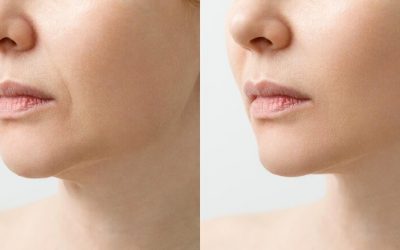 NECK FAT REMOVAL￼