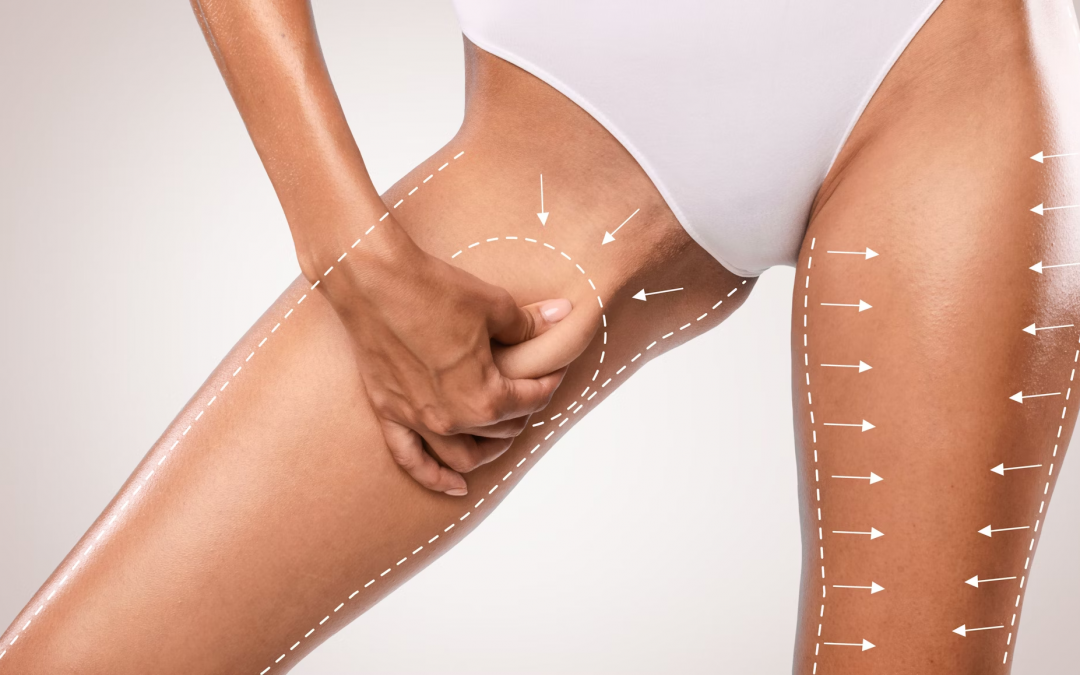Everything You Need To Know About Thigh Liposuction for Slimmer Legs