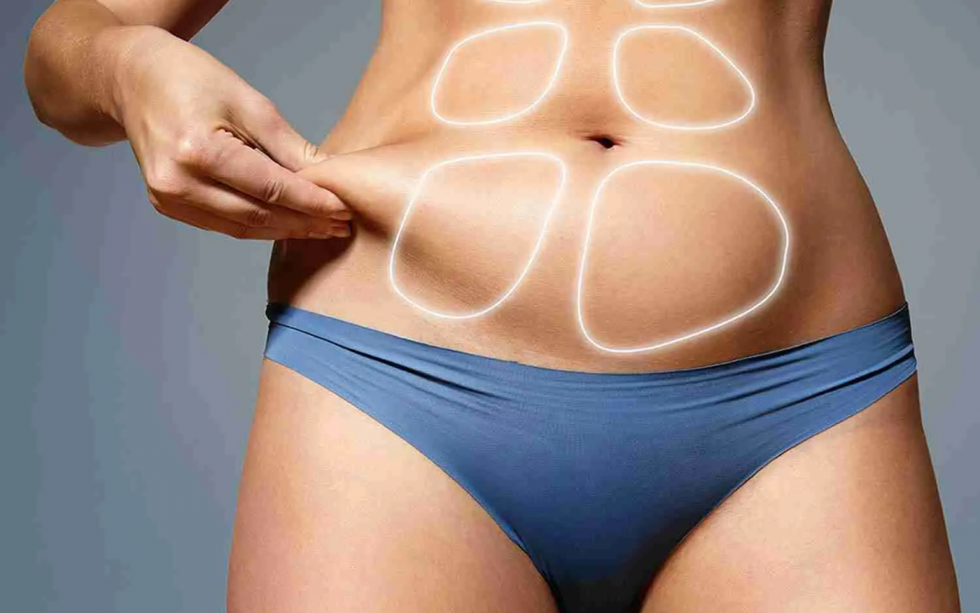 BodyTite Liposuction: Here’s Why It Enhances Skin Tightening Results