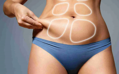BodyTite Liposuction: Here’s Why It Enhances Skin Tightening Results