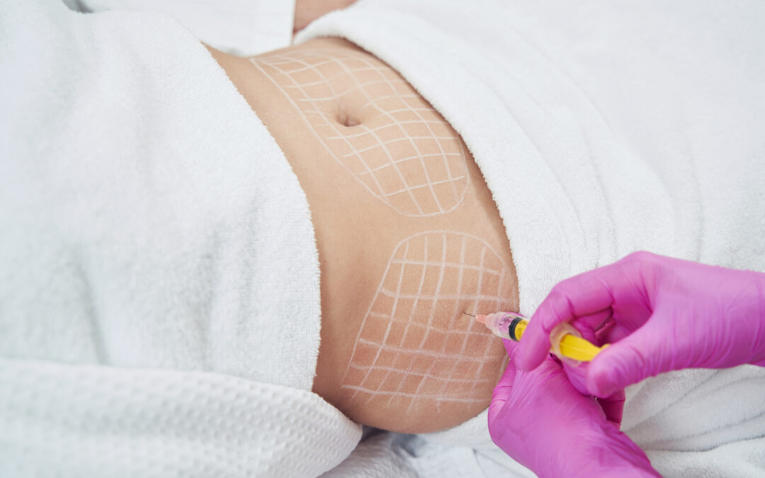 Hip liposuction in London cost factors explained during consultation