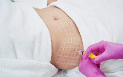 Hidden Costs of Recovery After Liposuction in London