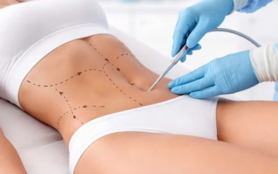 What to Do the Night Before Liposuction in London for Best Healing