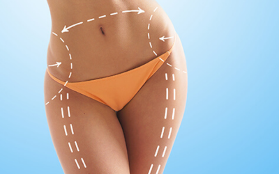 What Influences Cost for Hip Liposuction in London