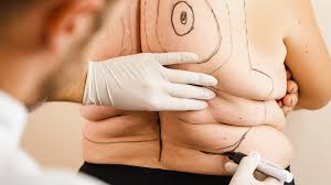 Can Back Fat Liposuction London Improve Posture After Weight Loss
