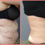 Stomach Fat removal Stomach Fat removal