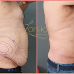Stomach fat removal